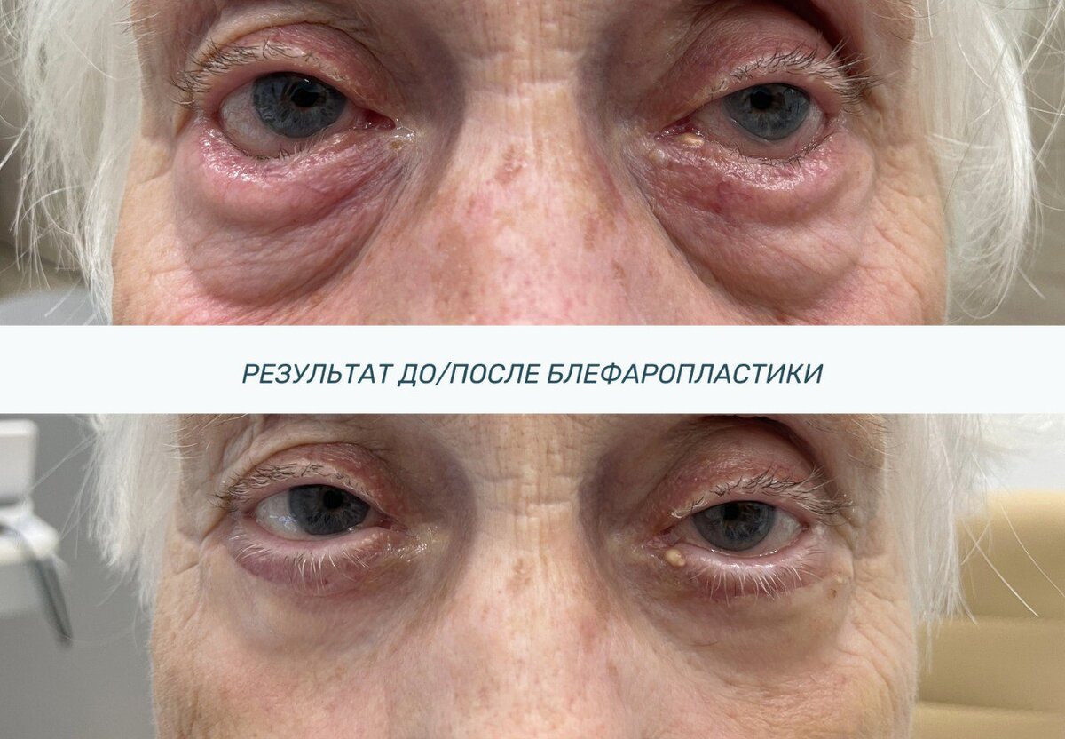 Нижняя блефаропластика с устранением заворота нижнего века. 
