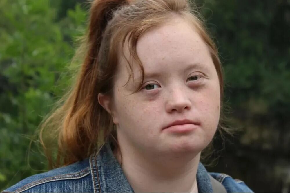 Девушка с синдромом Дауна ( фото для иллюстрации)