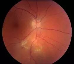 Острое течение, белесоватые очаги. Требуется срочное лечение. 