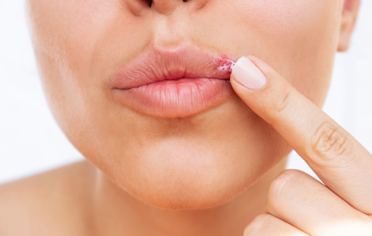 Герпетические высыпания на губах. Герпес на губе лечение домашними средствами