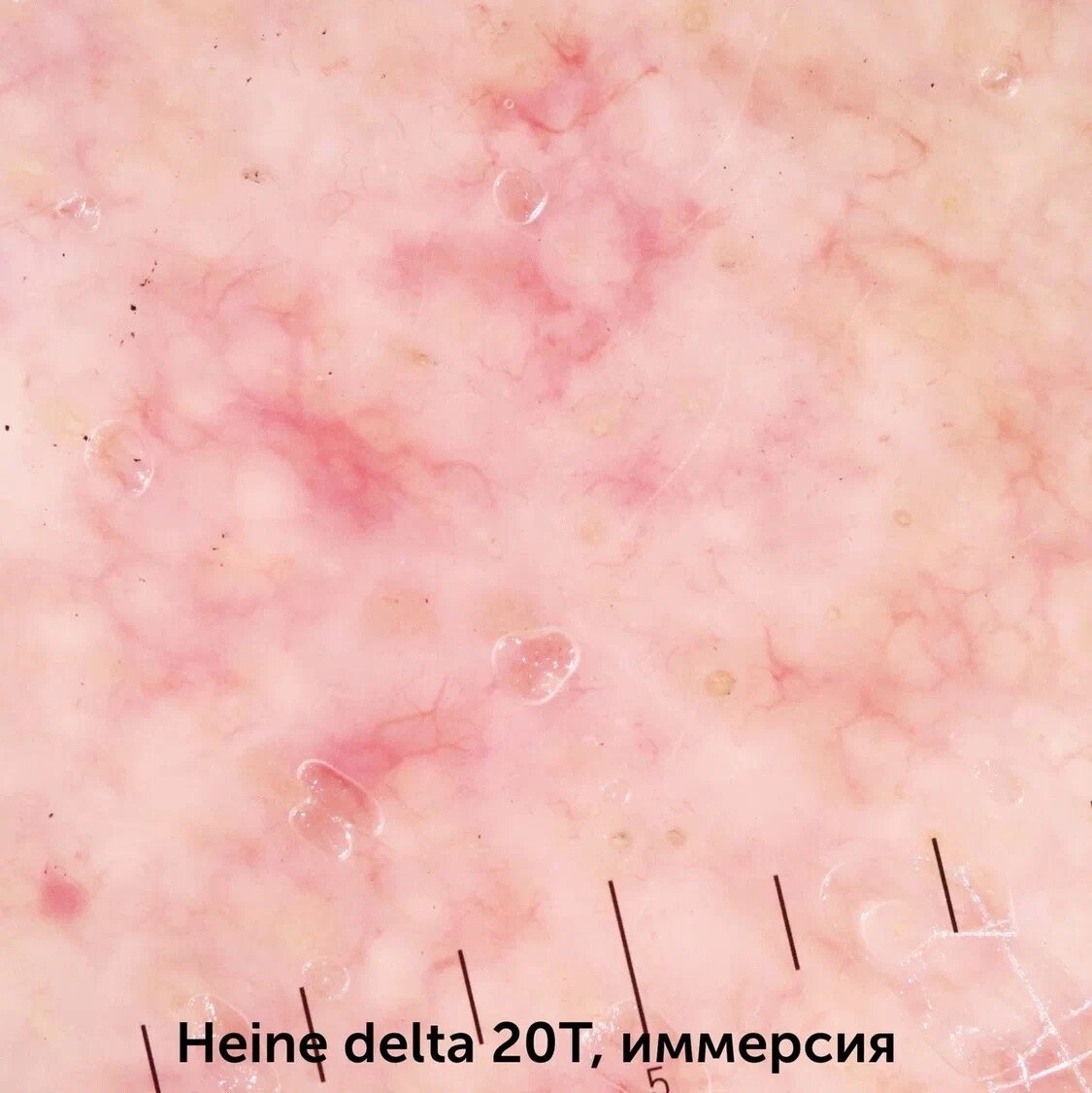 Базальноклеточная карцинома | Меланома Юнит СПб | Дзен