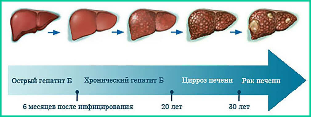 Классификация жирового гепатоза печени. Можно ли ребенку в год печень. Осложнения трансплантации печени. Можно ли собакам печень. Трансплантация части печени.