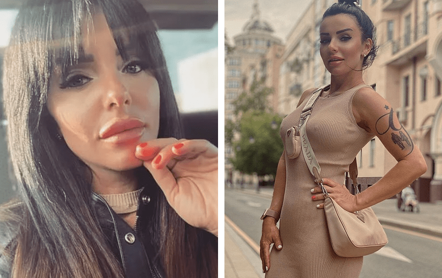 Инстасамка сдула губы фото до и после Инстасамка показала отёк на половину лица после удаления филлеров из губ