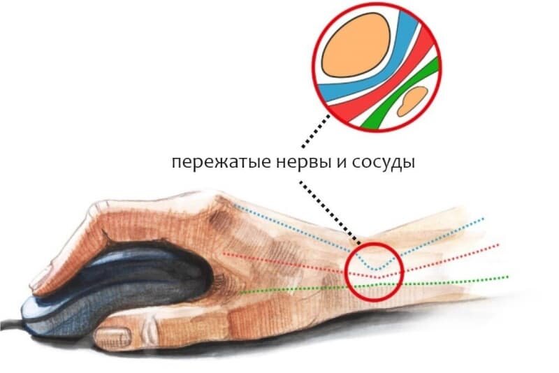 Туннельный синдром. Изображение из свободных источников 