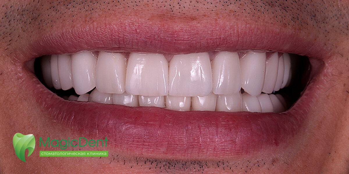 Тотальная реконструкция улыбки у пациента 38-ми лет
