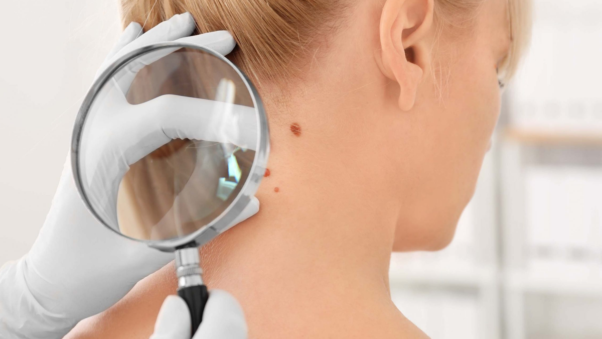 Чем может оказаться простая родинка? | Дерматолог Ольга Антонова | Дзен