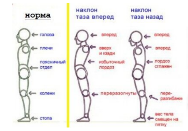 Примеры, когда таз завален вперед и назад