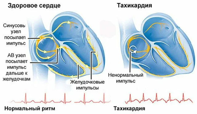 Учащенное сердцебиение при нагрузках. Тахикардия. Тахикардия сердца. Заболевание сердца тахикардия. Усиление сердцебиения.