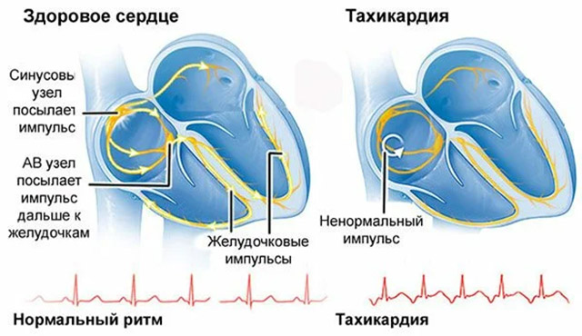 Учащенный пульс признаки. Тахикардия. Тахикардия сердца. Сердечные заболевания тахикардия. Усиление сердцебиения.