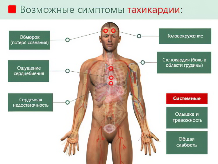 Резко сильное сердцебиение. Тахикардия симптомы. Тахикардические проявления. Симптомы при тахикардии. Симптомы учащенного сердцебиения.