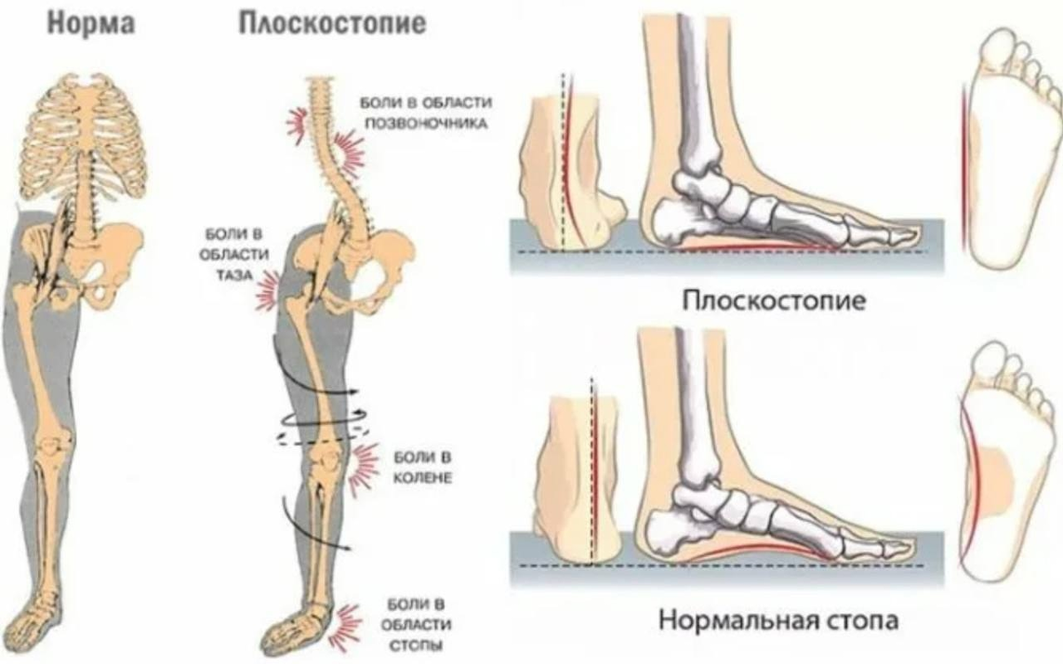 Уплощение стоп. Плоскостопие 3 степени вид сбоку. Плоскостопие высота свода. Плоскостопие высота свода стопы. Плоскостопие 3 степени высота свода.