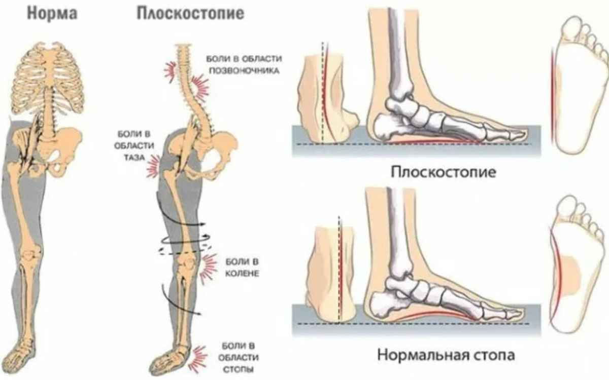 Лечение продольно поперечного плоскостопия. Плоскостопие 3 степени вид сбоку. Степени плоскостопия вид сбоку. Продольно-поперечное плоскостопие степени. Продольно-поперечное плоскостопие и вальгус 3 степени.