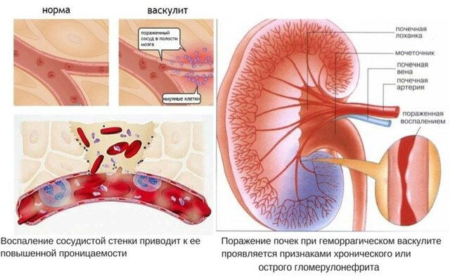 Васкулит геморрагический — что это, причины, симптомы, лечение