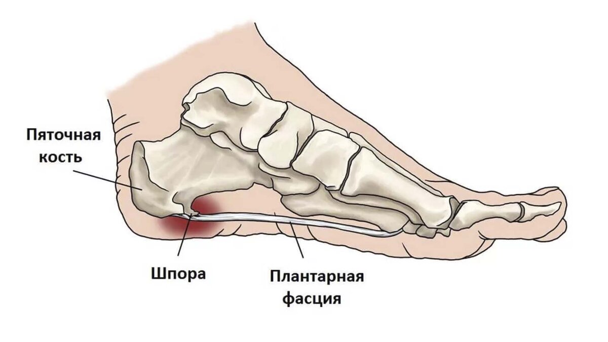 Пяточная шпора лечение в домашних условиях