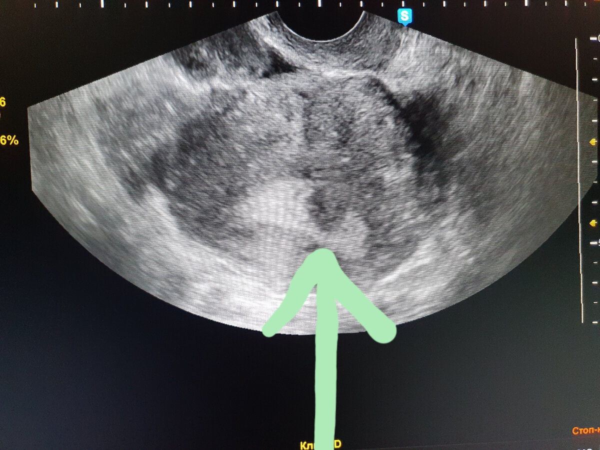Субмукозный узел в матке что это. Рождение субмукозного узла фото.