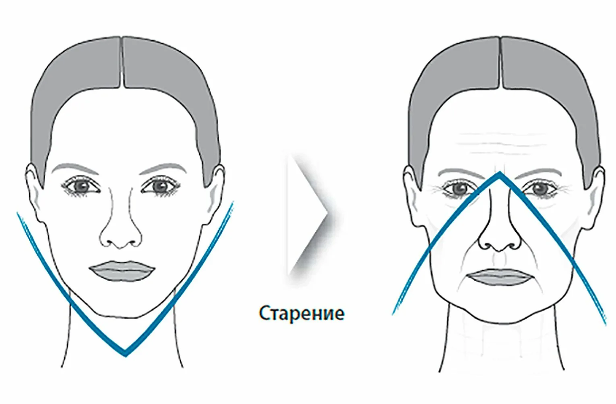 Техники коррекции. Векторный лифтинг Радиесс схема введения. Гравитационный птоз лица. Птоз овала лица. Изометрический лифтинг массаж лица.