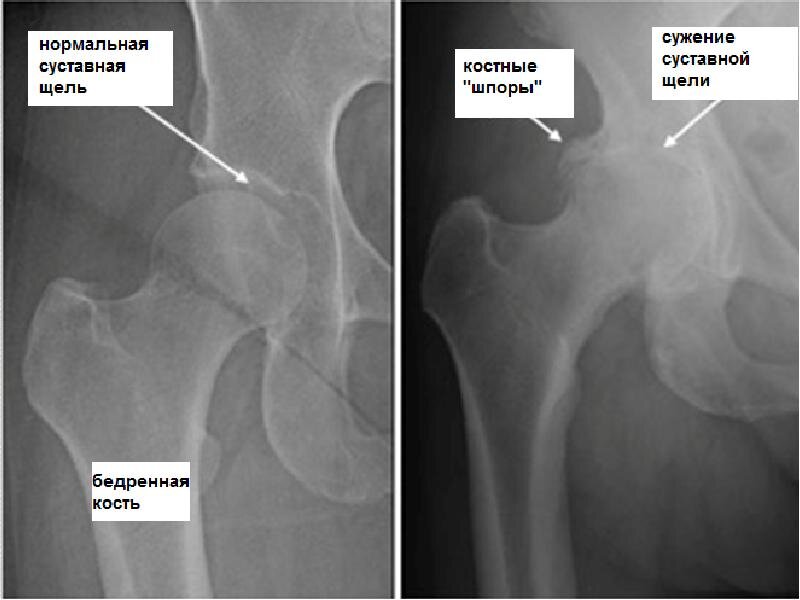 Артроз тазобедренного сустава 1 степени симптомы. Артроз тазобедренного сустава 1 степени симптомы. Артроз тазобедренного сустава 1 степени симптомы. Коксалгия тазобедренного сустава. Тазобедренный сустав анатомия коксартроз.