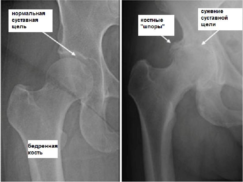 Признаки заболевания тазобедренного сустава. Коксартроз тазобедренного сустава 2 степени снимок. Коксартроз 2 степени рентген. Степени коксартроза тазобедренного сустава рентген. Остеоартроз тазобедренного сустава рентген стадии.
