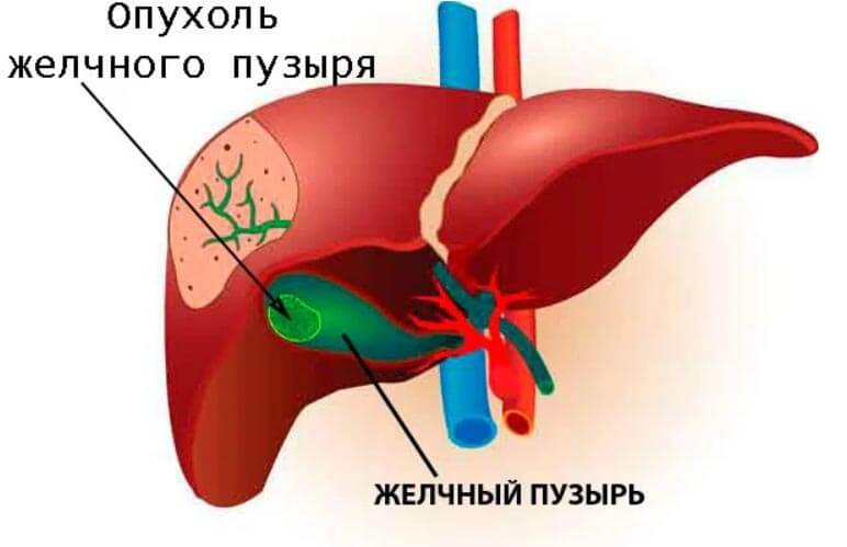 Опухоли желчного пузыря презентация