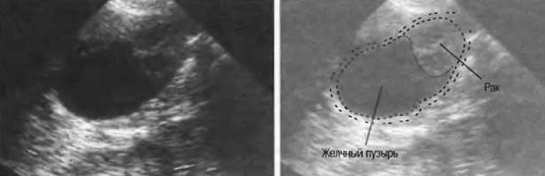 Полип стенки желчного пузыря. Объемные образования желчного пузыря УЗИ. Трансабдоминальная ультрасонография желчного пузыря. Аденома желчного пузыря УЗД. Полипоз желчного пузыря рентгенограмма.