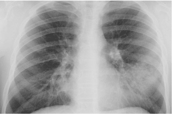    Рентген-признаки микоплазменной пневмонии / © Монастырщинская центральная районная больница