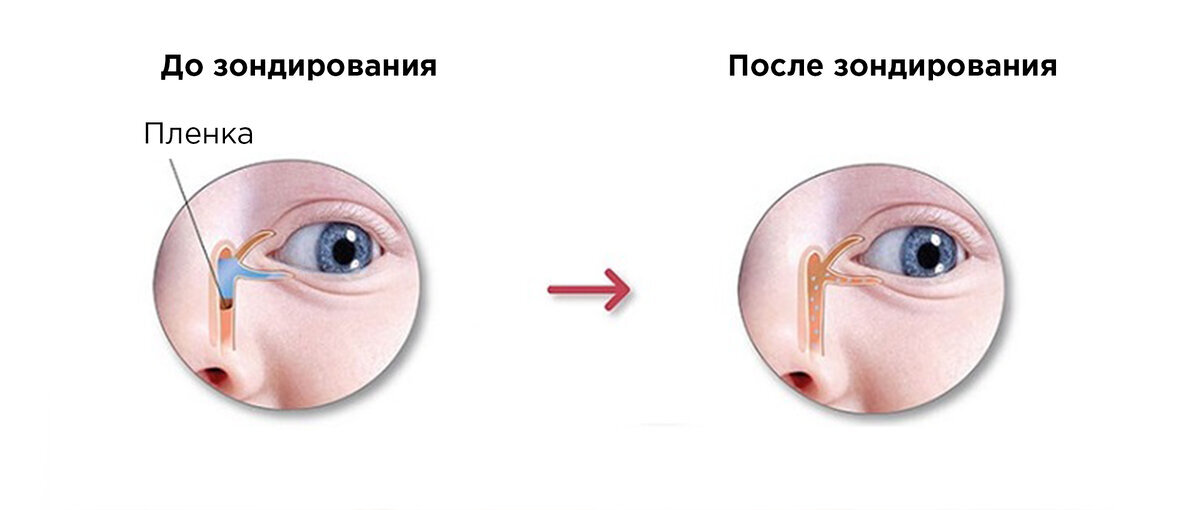 До и после зондирования слезного канала.