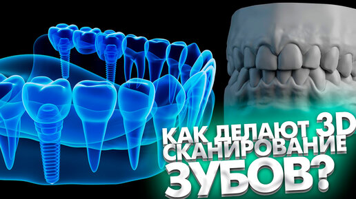 Как проводится 3D сканирование зубов?