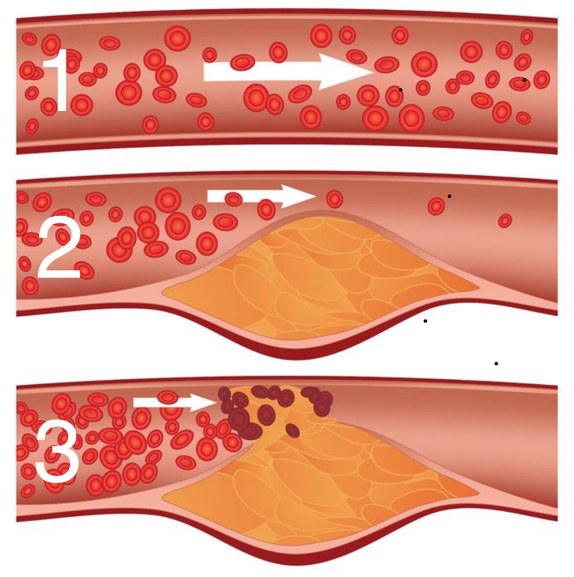 Схематичное изображение здорового сосуда (1), сосуда с атеросклеротической бляшкой (2), разрыва атеросклеротической бляшки и тромбоза(3)
