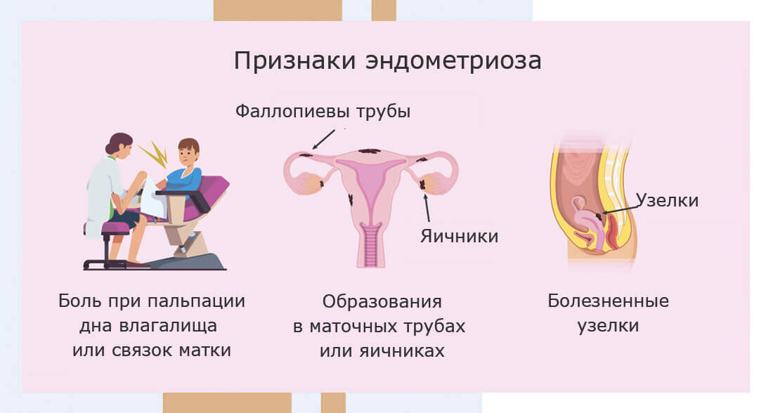 Чем лечить эндометриоз у женщин после 30. Чем лечить эндометриоз у женщин после 30