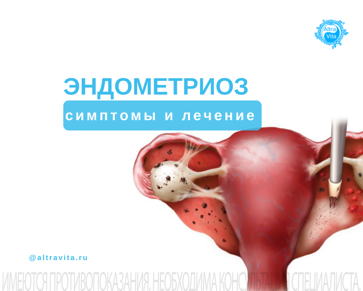 Эндометриоз: симптомы и лечение