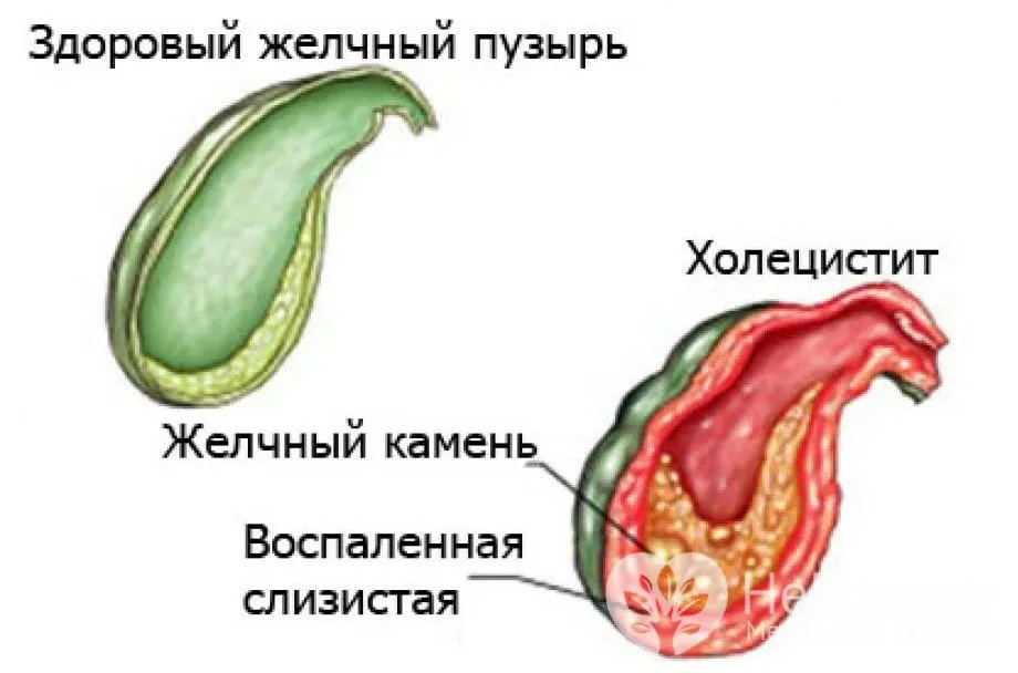 Как должен выглядеть желчный пузырь Болит правый бок - причины воспаления при холецистите: роль инфекции и питания О