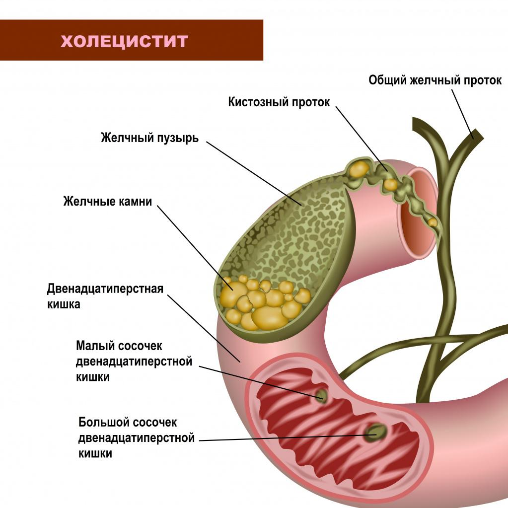 Холецистит кишечника