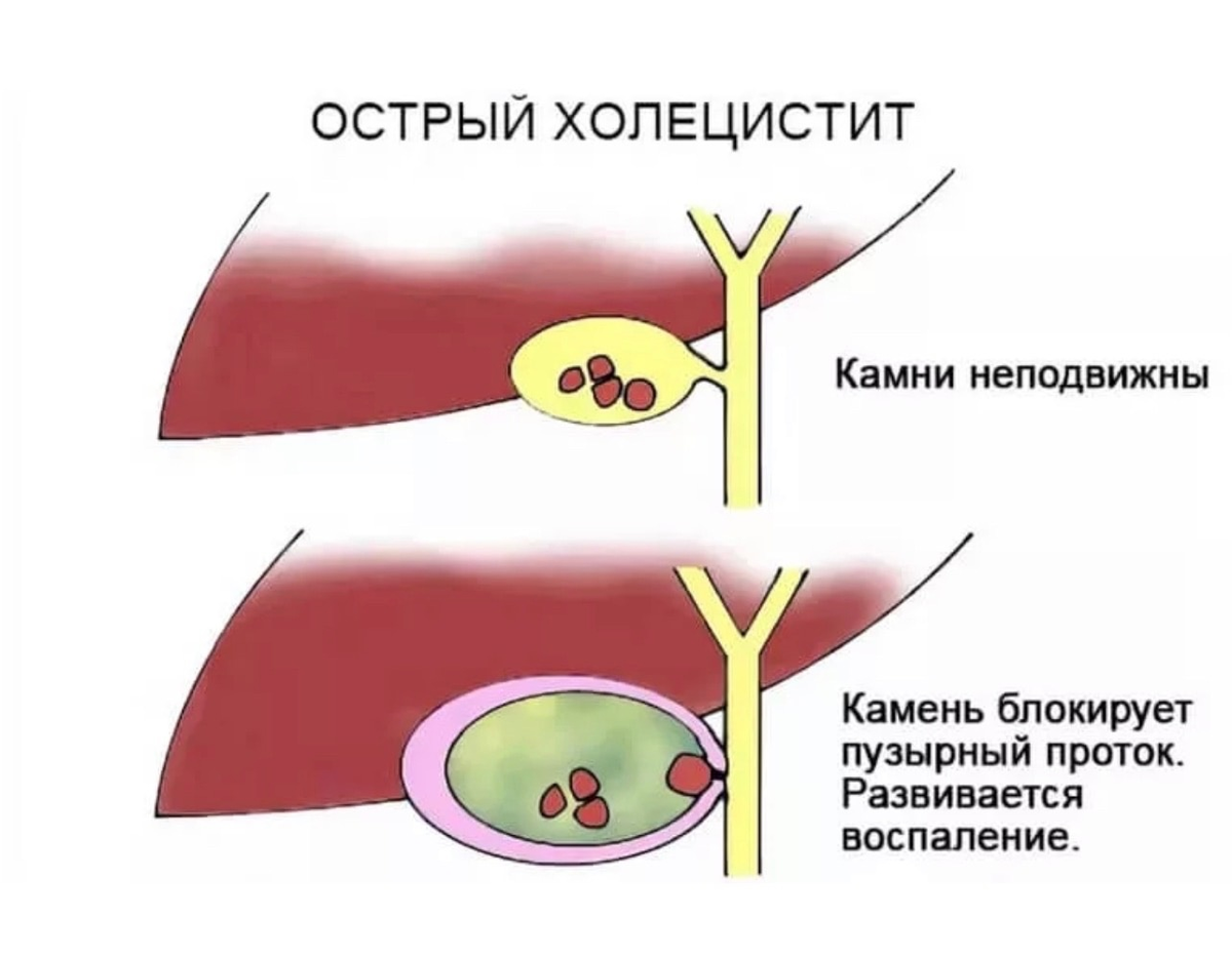 Холецистит вызывает. Острый билиарный холецистит. Острый холецистит желчного пузыря. Холецистит воспаление желчного пузыря. Хронический калькулезный холецистит.