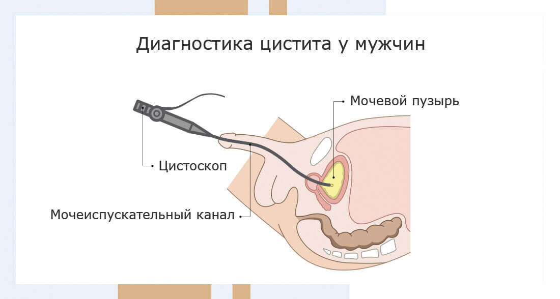 Цистит лечение народными средствами - Shaman Натуральная медицина. Продукты, лечение и консультации