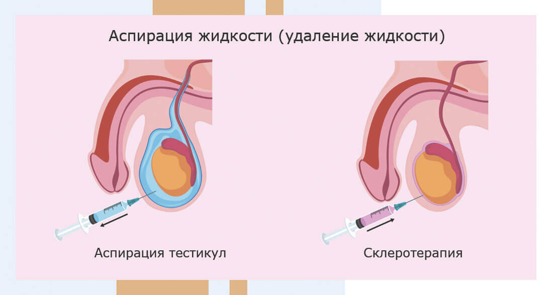 Лечение гидроцеле без операции