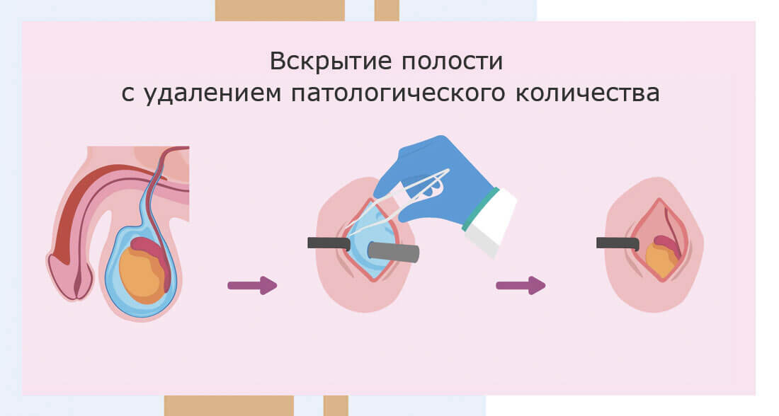 Гидроцеле - лечение водянки яичка | Клиника «АльтраВита» | Дзен