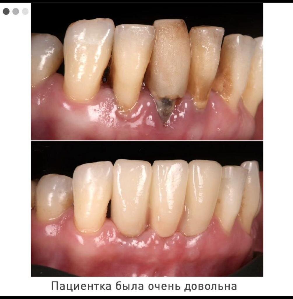 ЛЕЧЕНИЕ ПАРОДОНТИТА | Спасибо.Клиник | Дзен
