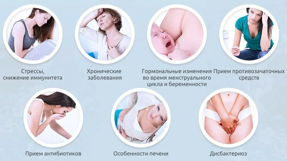 Молочница – причины, симптомы, диагностика и лечение