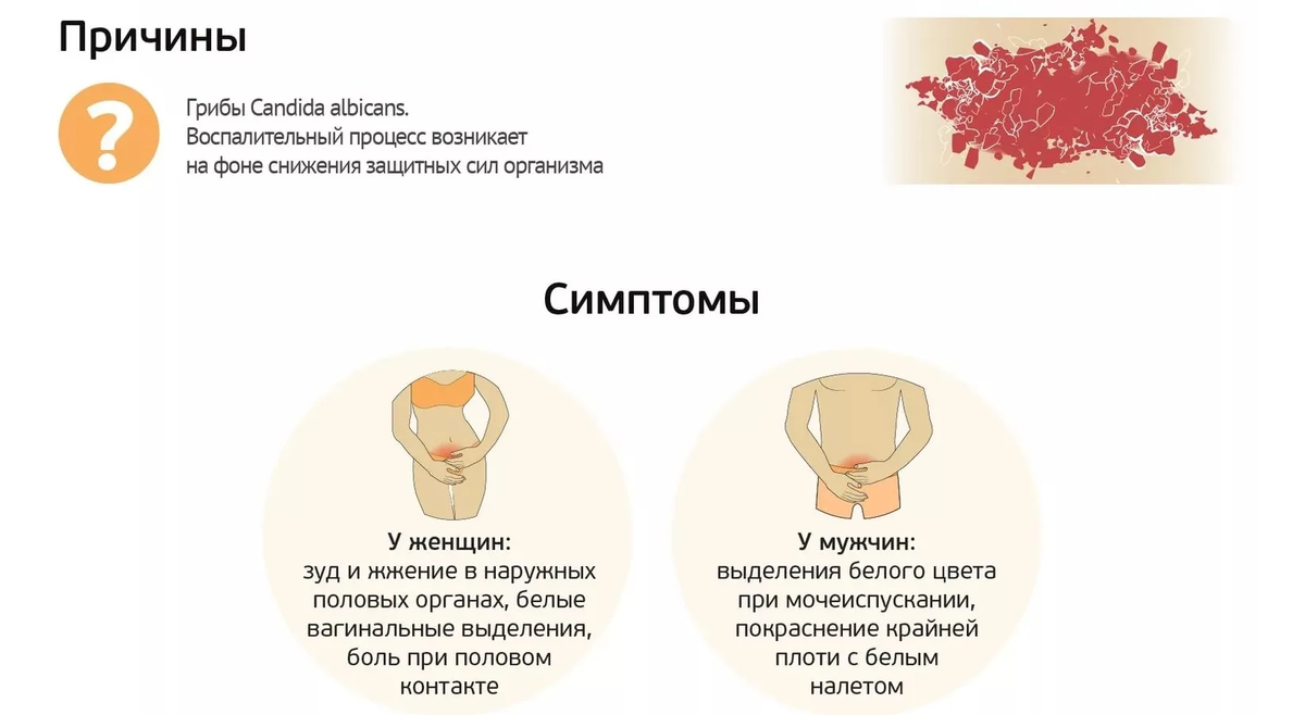 Молочница у женщин