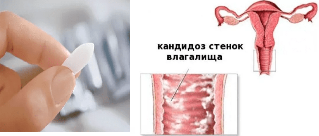 Молочница - Good Health