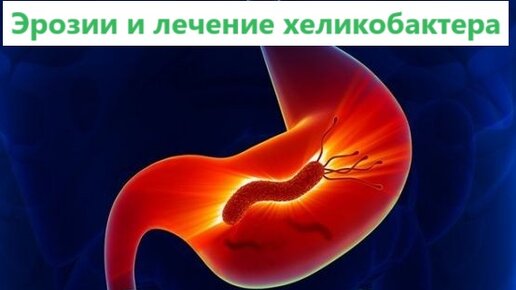 Эрозии и лечение хеликобактера. | Доктор Силантьева | Дзен