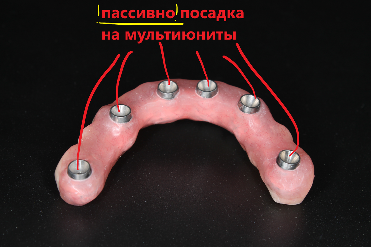 Временный адаптационный протез с опорой на 6 имплантов. 