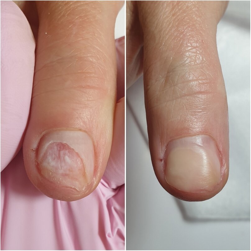 Создать карусельНоготь до и после после реставрации