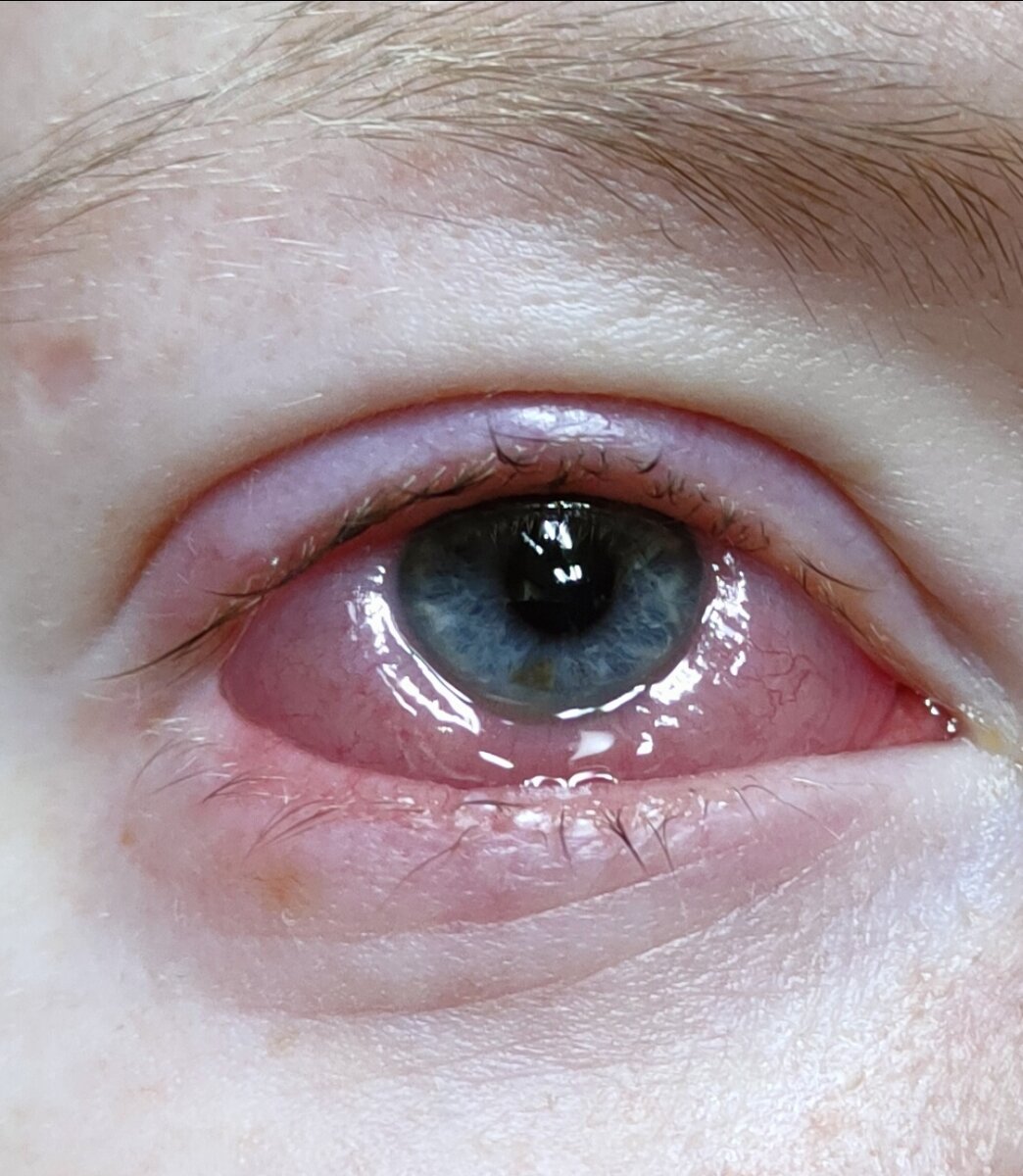 Ух, люблю я терпеть и тянуть резину. Тут мне ставили укол в веко, чтоб снять воспаление.