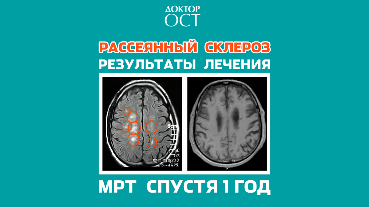 Лечение рассеянного склероза | Доктор ОСТ | Центр лечения позвоночника ...