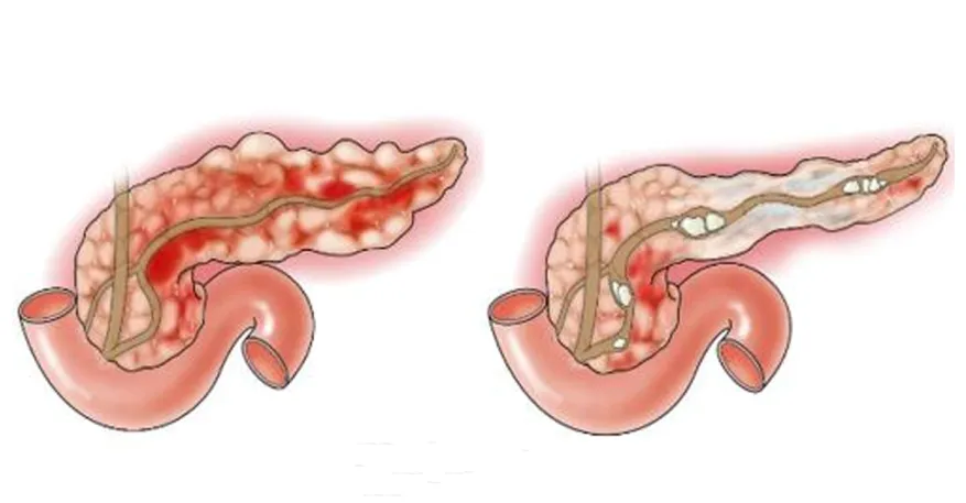 Болит в левом боку – в чем опасность панкреатита у взрослых и как его ...