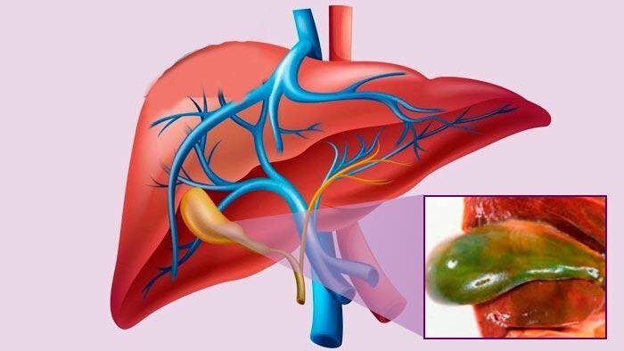 эмпиема желчного пузыря это. хронический калькулезный холецистит узи. острый катаральный холецистит. жкб эмпиема желчного пузыря. эмпиема желчного пузыря клиника.