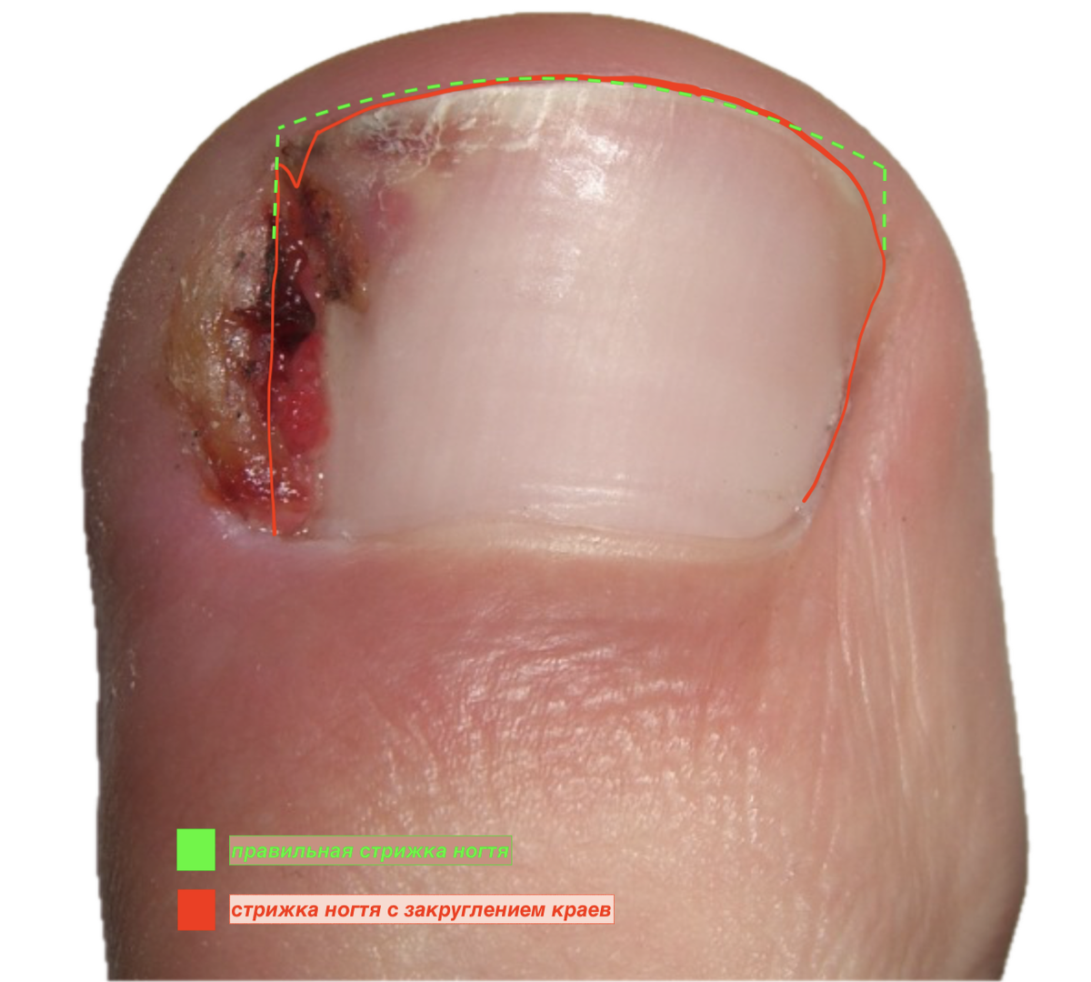 Острый край ногтя проникает в мягкие ткани пальца стопы (боковой валик)