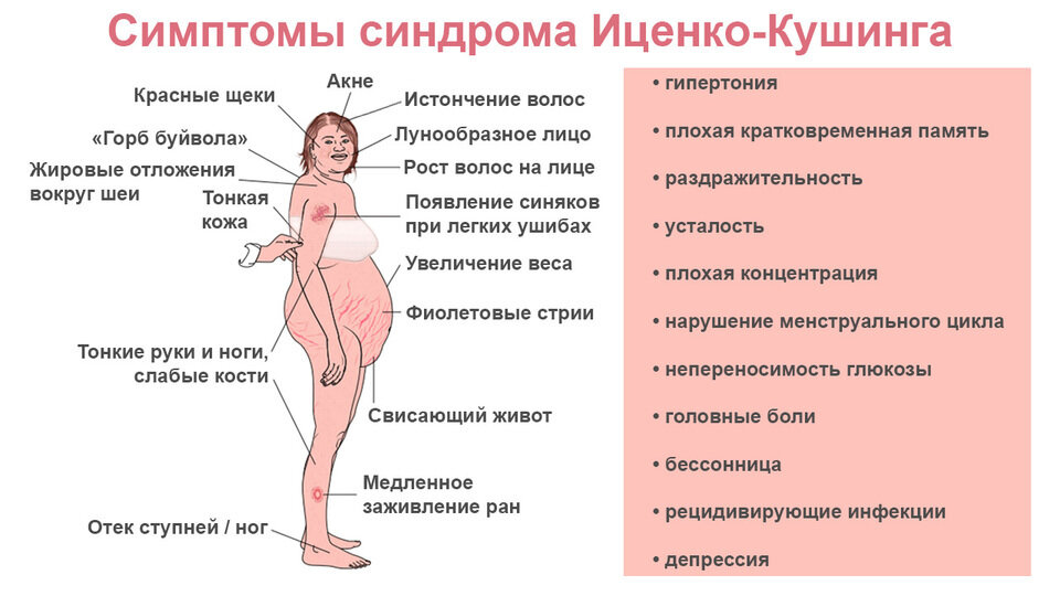  Типичные проявления синдрома Иценко-Кушинга. Источник: Thierry Brue, Frederic Castinetti, Orphanet Journal of Rare Diseases / ResearchGate (CC BY 4.0)