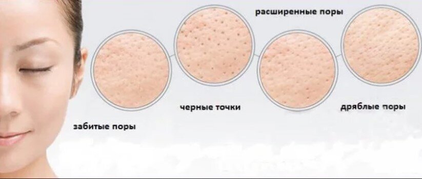 Расширенные поры - как избавиться, причины и лечение